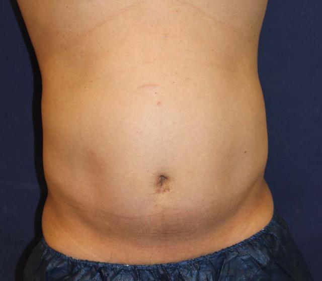 Liposuction before at La Jolla Plastic Surgery & Dermatology in San Diego, CA