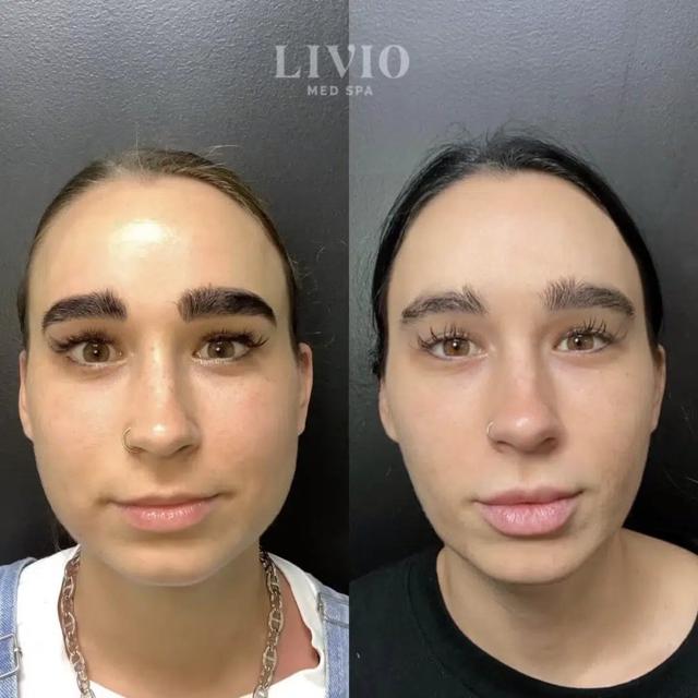 Botox result at Livio Med Spa in Cincinnati, OH