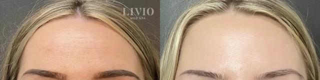 Botox result at Livio Med Spa in Cincinnati, OH