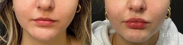 Lip Filler result at Livio Med Spa in Cincinnati, OH