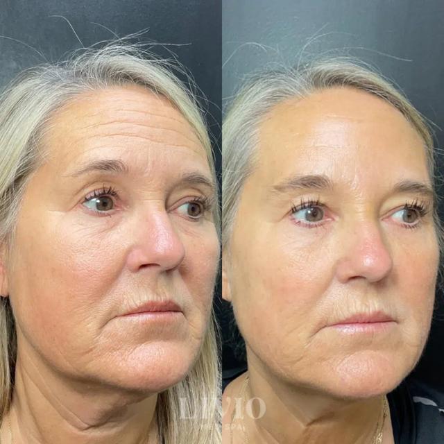 Microneedling result at Livio Med Spa in Cincinnati, OH