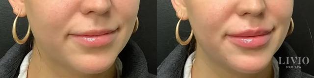 Lip Filler result at Livio Med Spa in Cincinnati, OH
