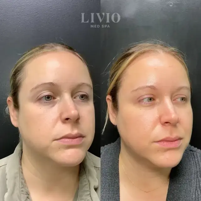 Dermal Fillers result at Livio Med Spa in Cincinnati, OH