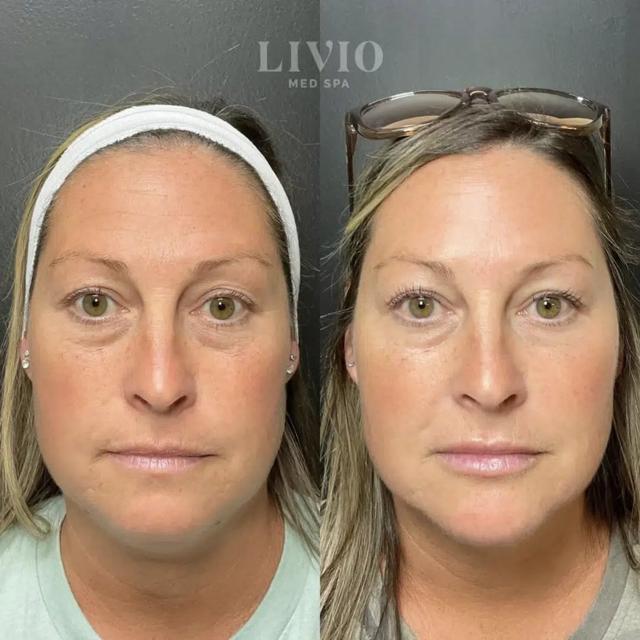 Botox result at Livio Med Spa in Cincinnati, OH