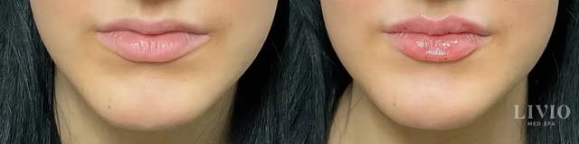 Lip Filler result at Livio Med Spa in Cincinnati, OH