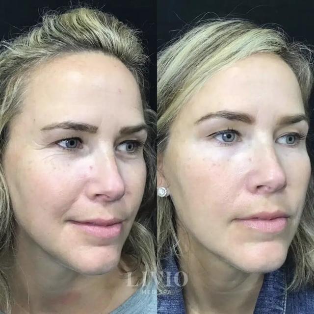 Botox result at Livio Med Spa in Cincinnati, OH