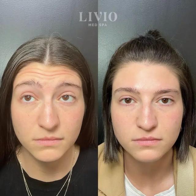 Botox result at Livio Med Spa in Cincinnati, OH
