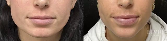 Botox result at Livio Med Spa in Cincinnati, OH