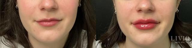 Lip Filler result at Livio Med Spa in Cincinnati, OH