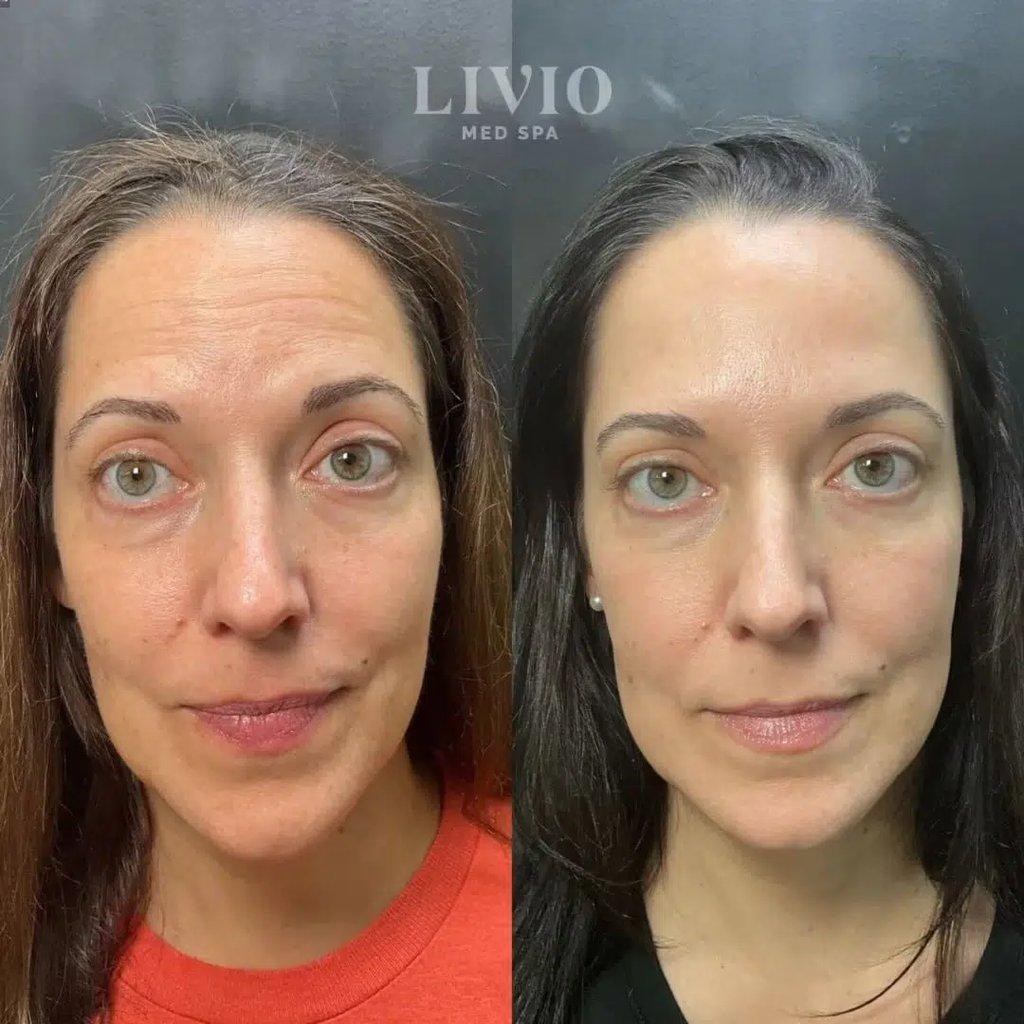 Livio Med Spa microneedling result — Cincinnati, OH