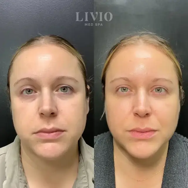 Juvederm result at Livio Med Spa in Cincinnati, OH