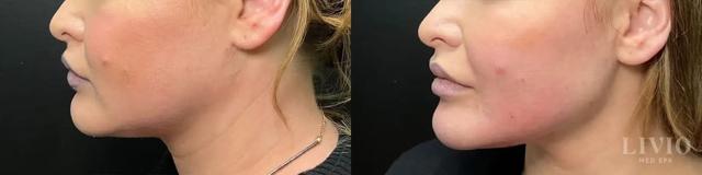Jawline Filler result at Livio Med Spa in Cincinnati, OH