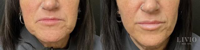 Botox result at Livio Med Spa in Cincinnati, OH