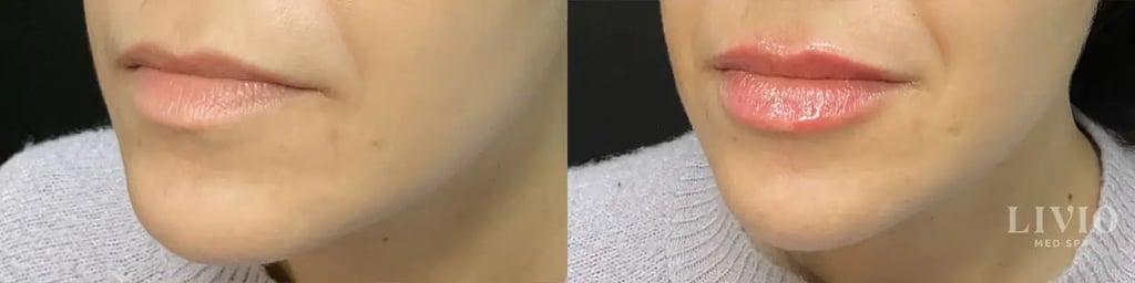 Livio Med Spa lip filler result — Cincinnati, OH
