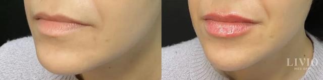 Lip Filler result at Livio Med Spa in Cincinnati, OH