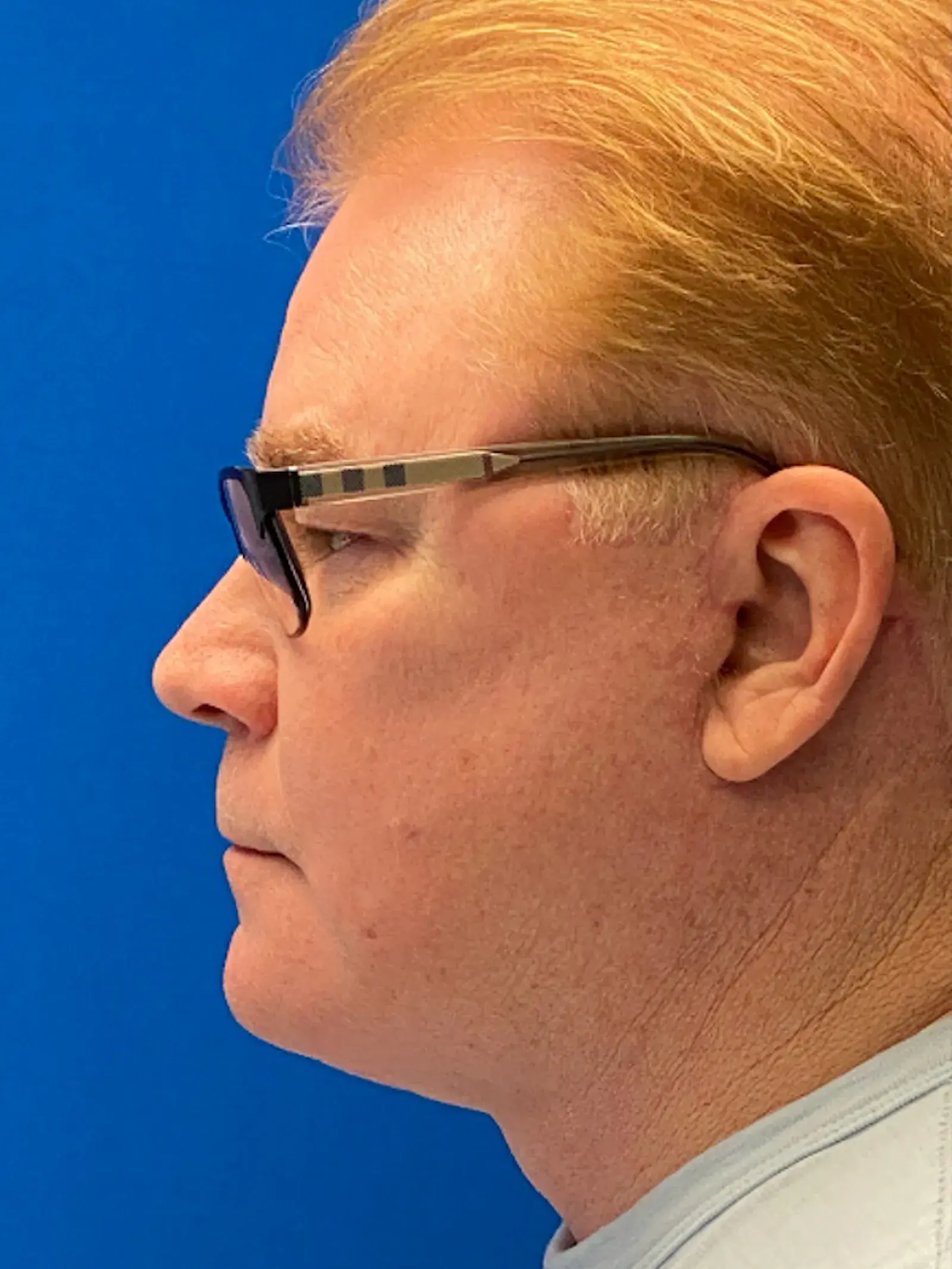 Dr. Paul Afrooz facelift after — Coral Gables, FL