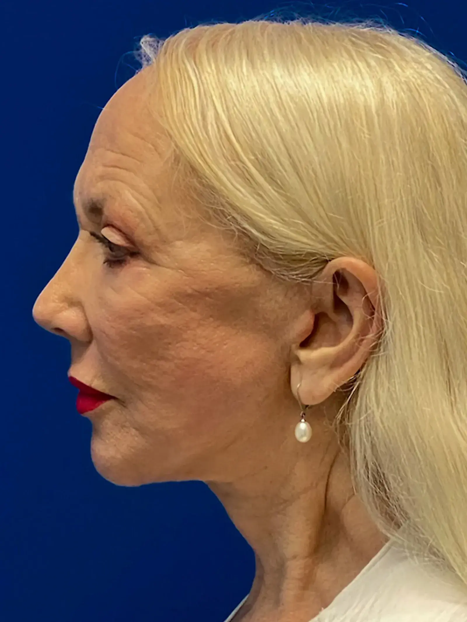 Dr. Paul Afrooz facelift after — Coral Gables, FL