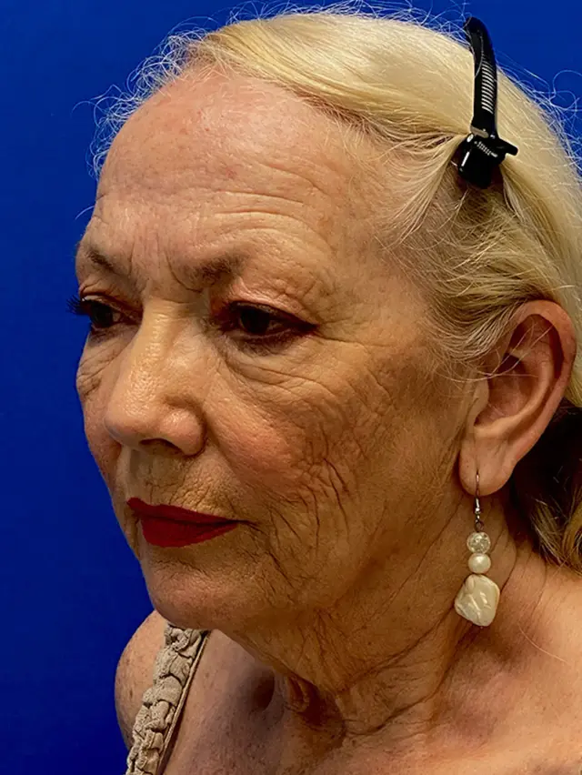 Facelift before at Dr. Paul Afrooz in Coral Gables, FL