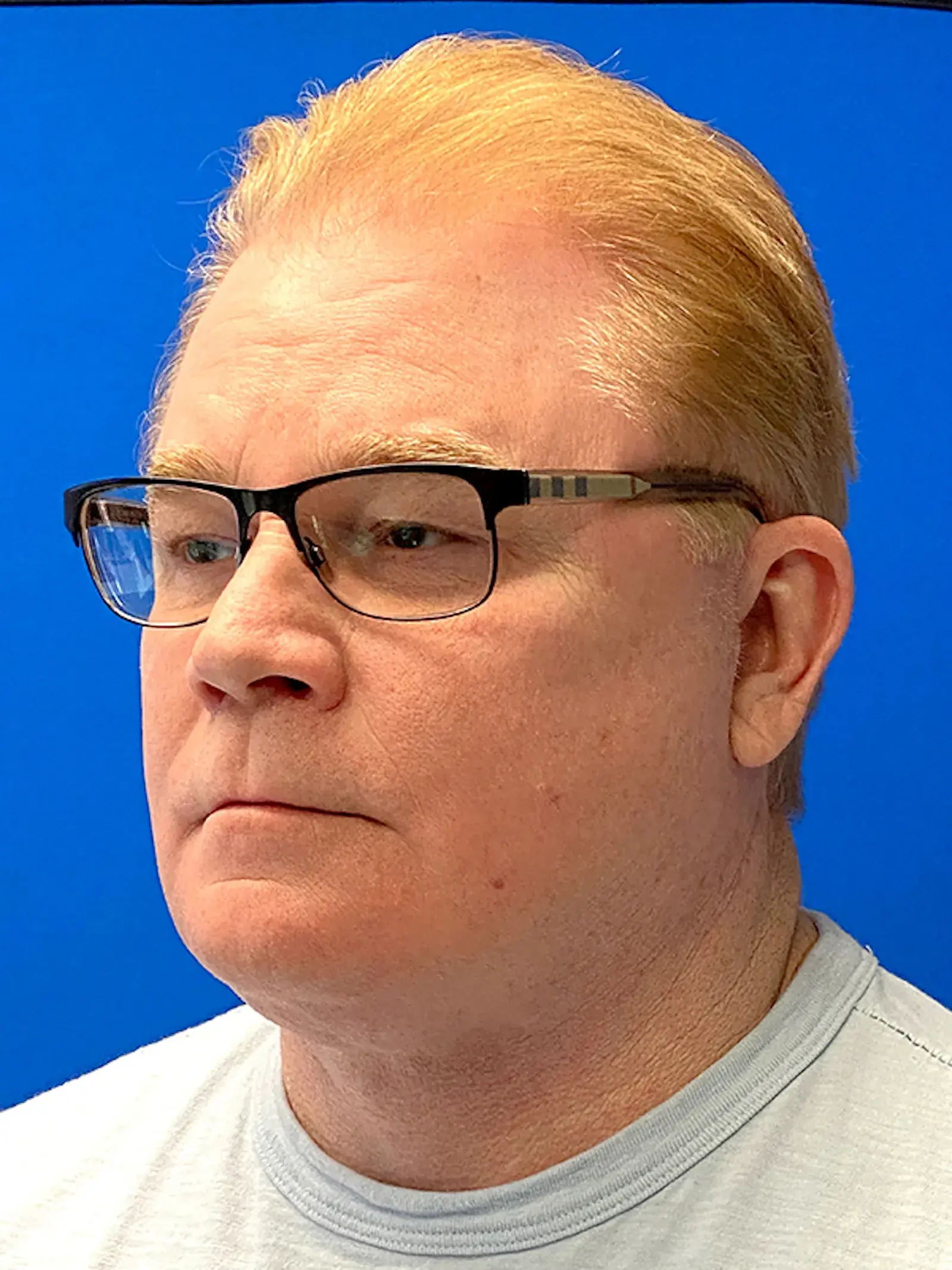 Dr. Paul Afrooz facelift after — Coral Gables, FL