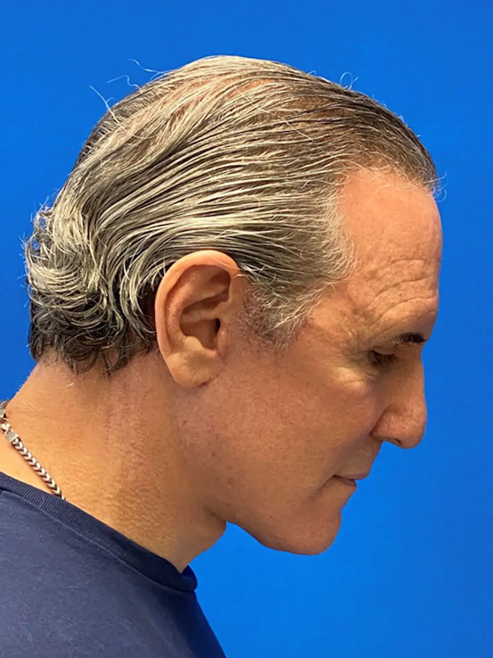 Dr. Paul Afrooz facelift after — Coral Gables, FL