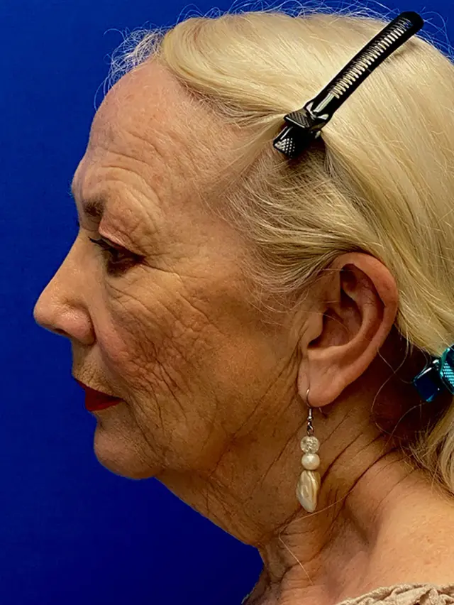 Facelift before at Dr. Paul Afrooz in Coral Gables, FL