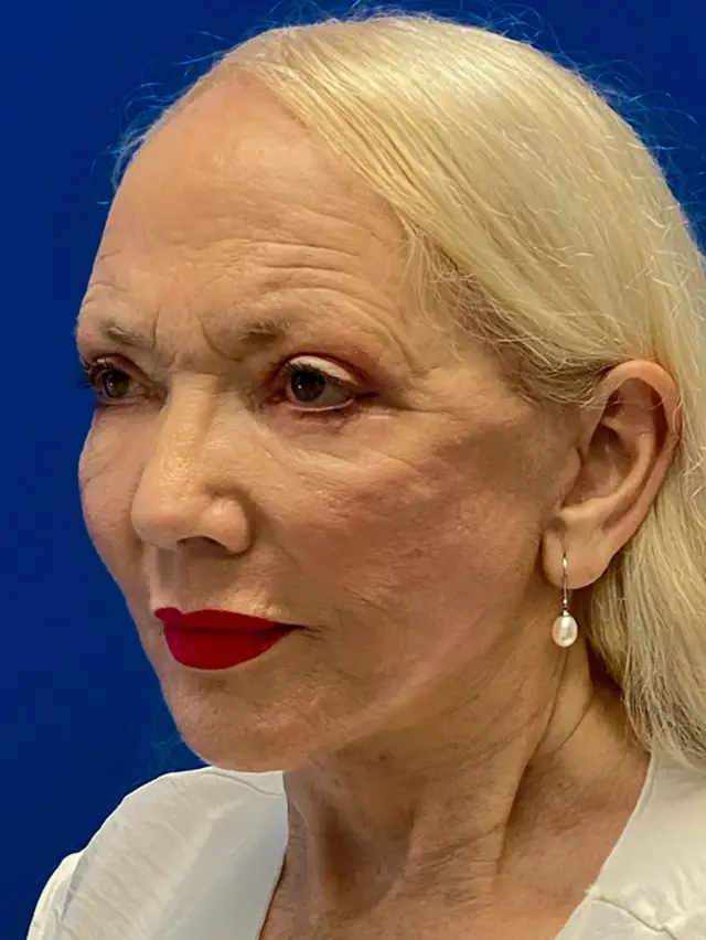 Facelift after at Dr. Paul Afrooz in Coral Gables, FL