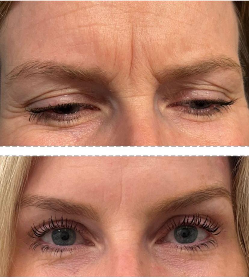 Summit Medical Spa botox result — Spanish Fork, UT