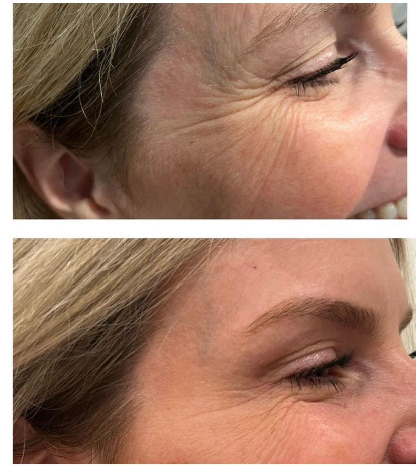Summit Medical Spa botox result — Spanish Fork, UT