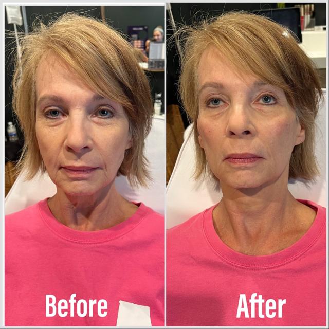 Dermal Fillers result at Summit Medical Spa in Spanish Fork, UT