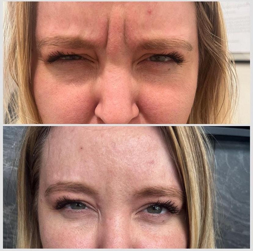 Summit Medical Spa botox result — Spanish Fork, UT