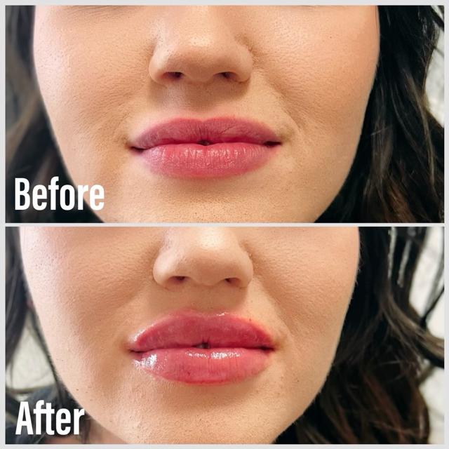 Lip Filler result at Summit Medical Spa in Spanish Fork, UT