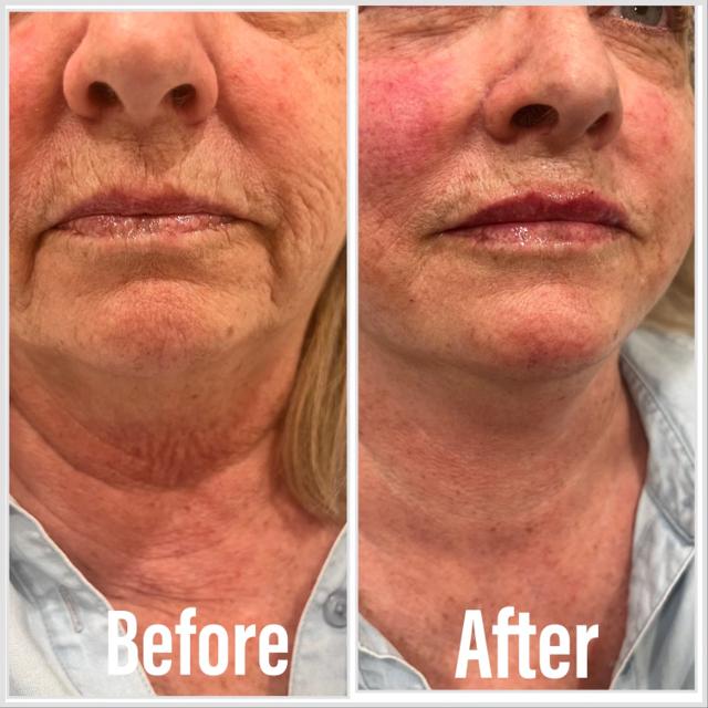 Lip Filler result at Summit Medical Spa in Spanish Fork, UT