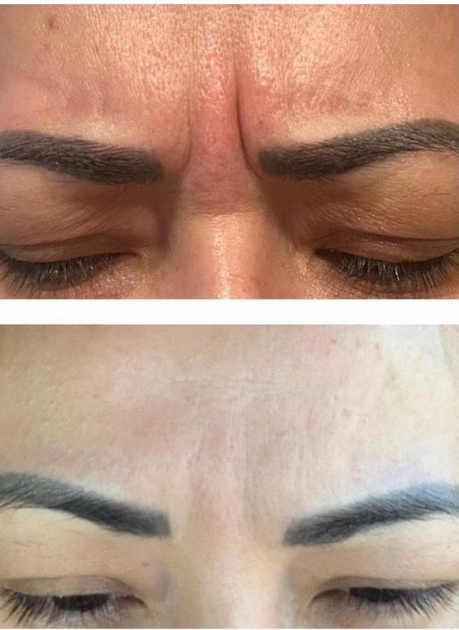 Summit Medical Spa botox result — Spanish Fork, UT