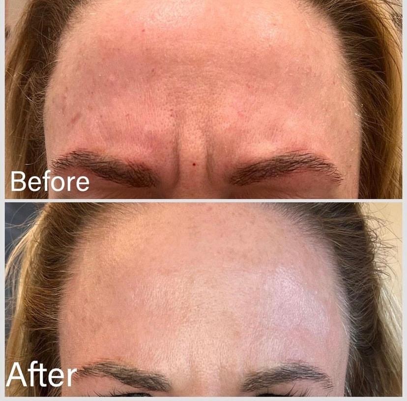 Summit Medical Spa botox result — Spanish Fork, UT