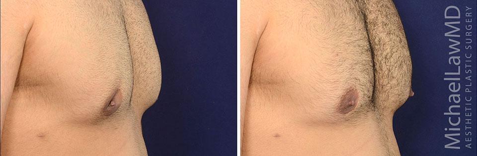 Michael Law MD Aesthetic Plastic Surgery gynecomastia result — Raleigh, NC