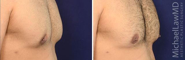 Gynecomastia Surgery result at Michael Law MD Aesthetic Plastic Surgery in Raleigh, NC