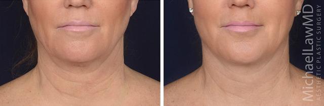 Neck Lift result at Michael Law MD Aesthetic Plastic Surgery in Raleigh, NC