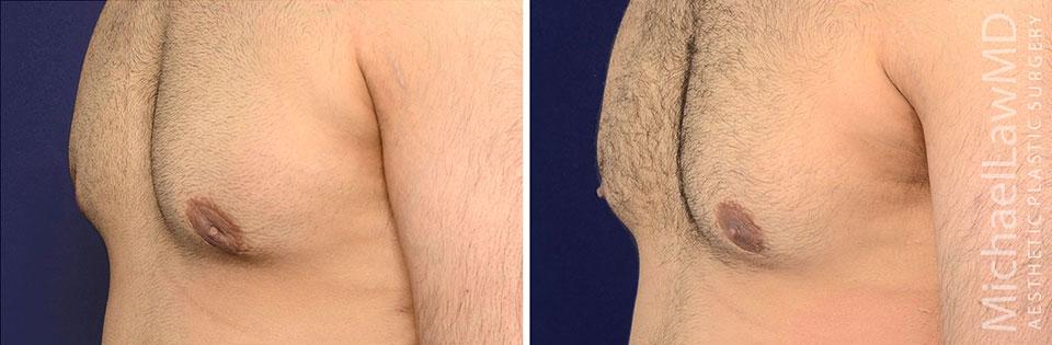 Michael Law MD Aesthetic Plastic Surgery gynecomastia result — Raleigh, NC