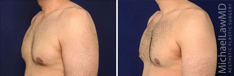 Michael Law MD Aesthetic Plastic Surgery gynecomastia result — Raleigh, NC