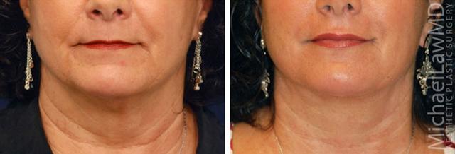 Neck Lift result at Michael Law MD Aesthetic Plastic Surgery in Raleigh, NC