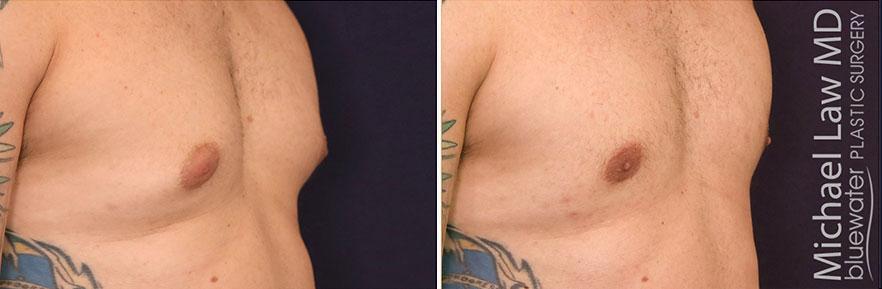 Michael Law MD Aesthetic Plastic Surgery gynecomastia result — Raleigh, NC