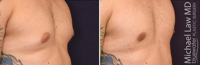 Gynecomastia Surgery result at Michael Law MD Aesthetic Plastic Surgery in Raleigh, NC