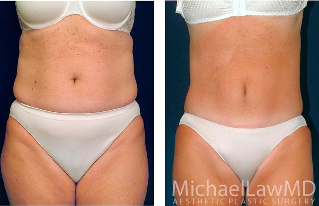 Tummy Tuck result at Michael Law MD Aesthetic Plastic Surgery in Raleigh, NC