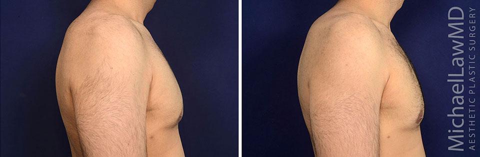Michael Law MD Aesthetic Plastic Surgery gynecomastia result — Raleigh, NC