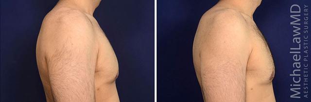 Gynecomastia Surgery result at Michael Law MD Aesthetic Plastic Surgery in Raleigh, NC