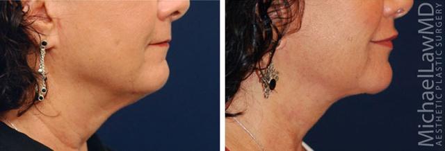 Neck Lift result at Michael Law MD Aesthetic Plastic Surgery in Raleigh, NC