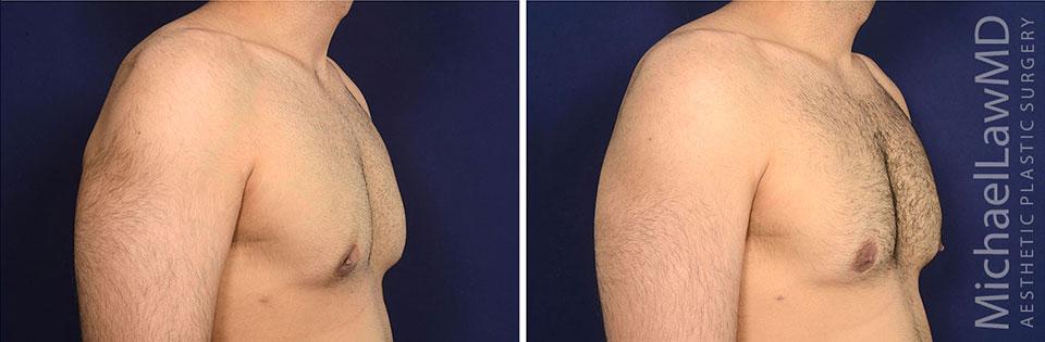 Michael Law MD Aesthetic Plastic Surgery gynecomastia result — Raleigh, NC