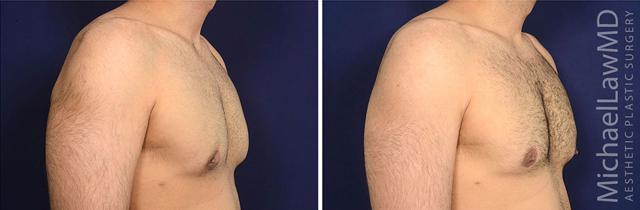 Gynecomastia Surgery result at Michael Law MD Aesthetic Plastic Surgery in Raleigh, NC