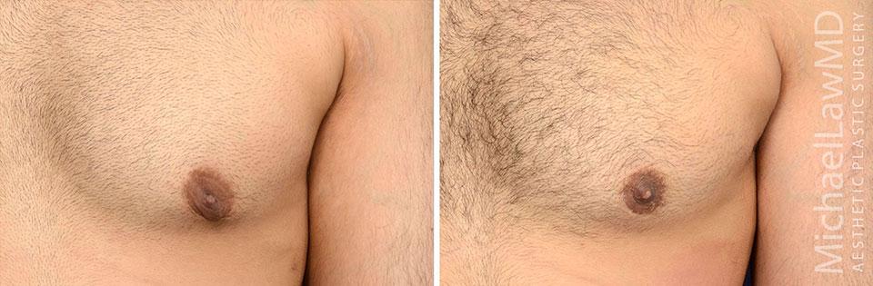 Michael Law MD Aesthetic Plastic Surgery gynecomastia result — Raleigh, NC