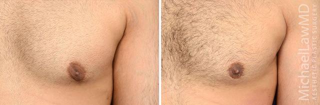 Gynecomastia Surgery result at Michael Law MD Aesthetic Plastic Surgery in Raleigh, NC